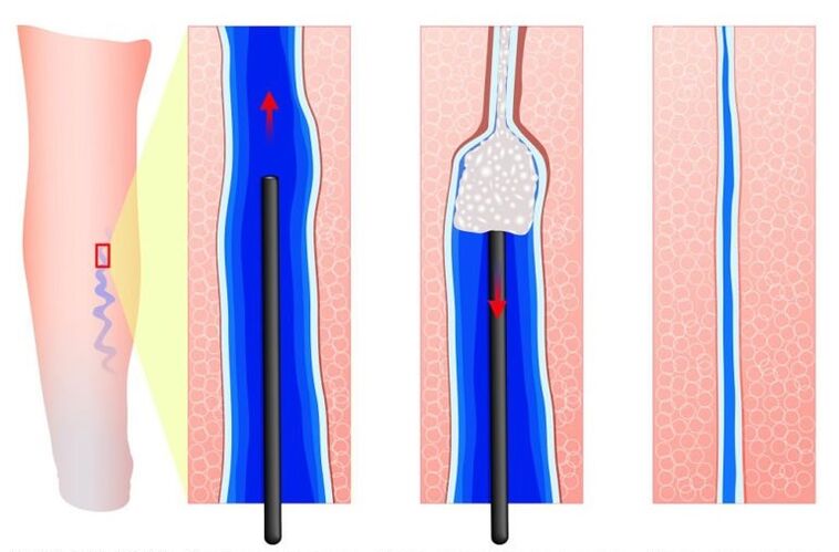 sclerotherapy do veins varicose an labia
