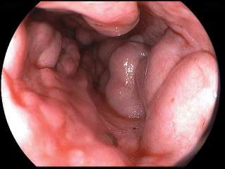veins varicose ar an esophagus